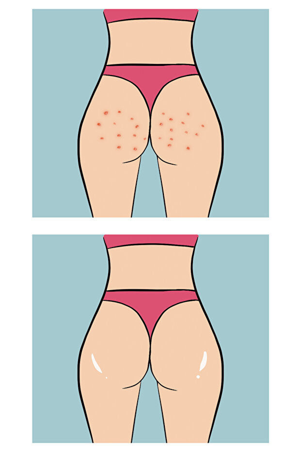 Buttoks Buttne Vücut Maskesi | Vücut Sivilceleri ve Pürüzlere Karşı