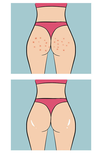 Buttoks Buttne Vücut Maskesi | Vücut Sivilceleri ve Pürüzlere Karşı