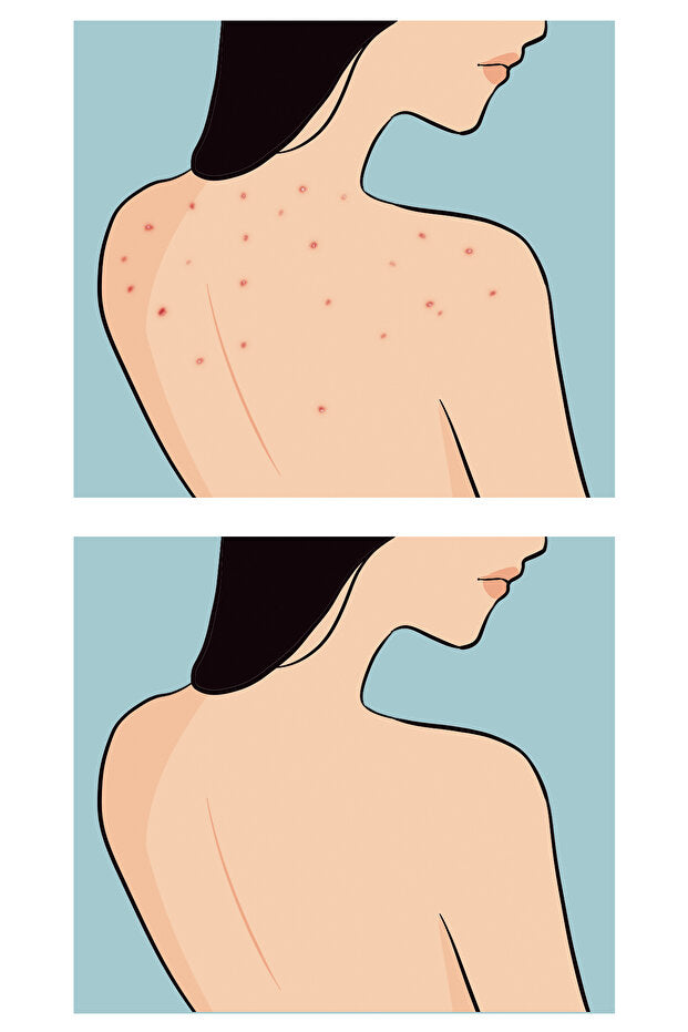 Buttoks Buttne Vücut Maskesi | Vücut Sivilceleri ve Pürüzlere Karşı