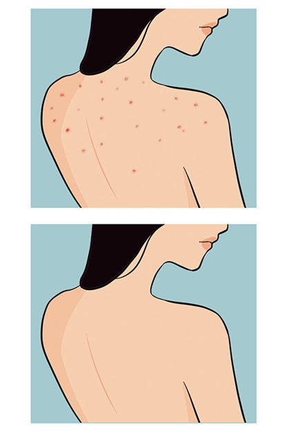 Buttoks Buttne Vücut Maskesi | Vücut Sivilceleri ve Pürüzlere Karşı