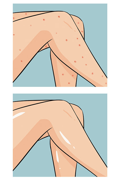 Buttoks Buttne Vücut Maskesi | Vücut Sivilceleri ve Pürüzlere Karşı